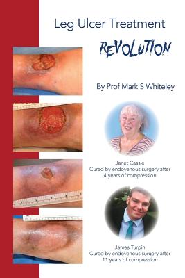 Leg Ulcer Treatment Revolution - Mark S. Whiteley