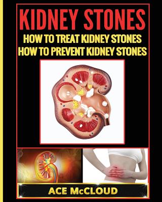 Kidney Stones: How To Treat Kidney Stones: How To Prevent Kidney Stones - Ace Mccloud