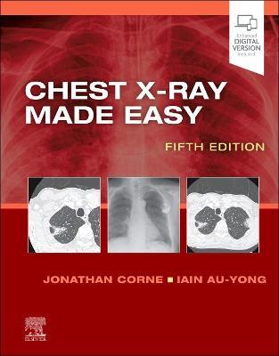 Chest X-Ray Made Easy - Jonathan Corne