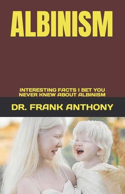 Albinism: Interesting Facts I Bet You Never Knew about Albinism - Frank Anthony