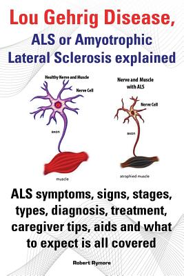 Lou Gehrig Disease, ALS or Amyotrophic Lateral Sclerosis Explained. ALS Symptoms, Signs, Stages, Types, Diagnosis, Treatment, Caregiver Tips, AIDS and - Robert Rymore