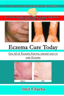 Eczema Cure Today - Get rid of Eczema forever natural ways to cure Eczema - Smit Chacha