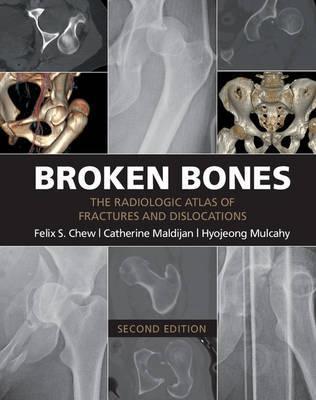 Broken Bones: The Radiologic Atlas of Fractures and Dislocations - Felix S. Chew