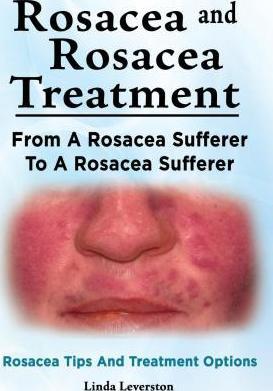 Rosacea and Rosacea Treatment. From A Rosacea Sufferer To A Rosacea Sufferer. Rosacea Tips And Treatment Options - Linda Leverston