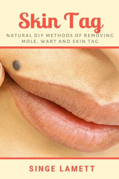 Skin Tag: Natural DIY Methods of removing Mole, Wart and Skin Tag - Singe Lamett