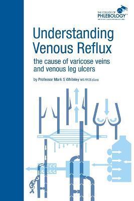 Understanding Venous Reflux the Cause of Varicose Veins and Venous Leg Ulcers: Varicose veins and venous leg ulcers - Mark S. Whiteley