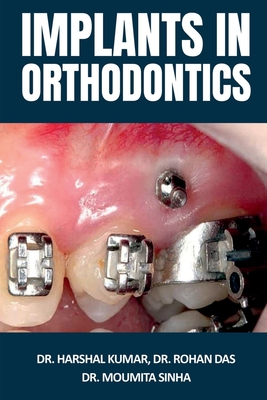 Implants in Orthodontics - Harshal