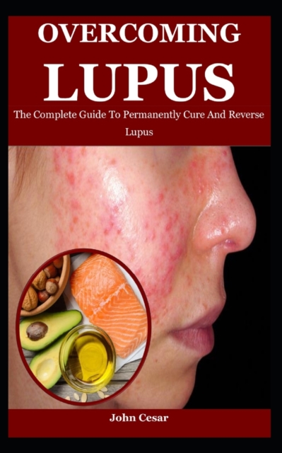 Overcoming Lupus: The Complete Guide To Permanently Cure And Reverse Lupus - John Cesar
