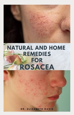 Natural and Home Remedies for Rosacea: A Self Help Guide To Completely Prevent and Treat Rosacea - Elizabeth David