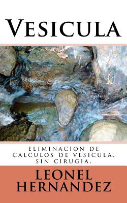 Vesicula: eliminacion de calculos de vesicula, sin cirugia. - J. L. Hernandez