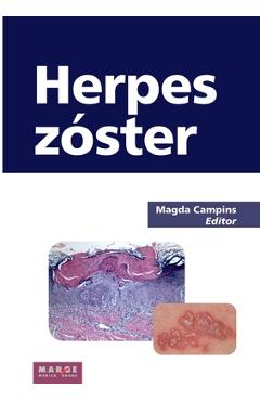 Herpes zóster - Magda Campins