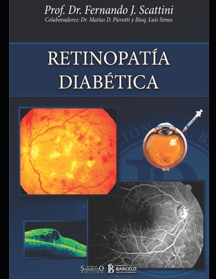 Retinopatía diabética: Oftalmología - Matías Pierotti