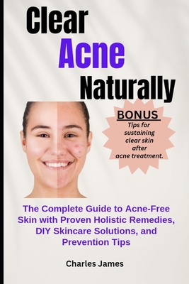 Clear Acne Naturally: The Complete Guide to Acne-Free Skin with Proven Holistic Remedies, DIY Skincare Solutions, and Prevention Tips - Charles James