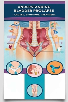 Understanding Bladder Prolapse - Causes, Symptoms, Treatment: Bladder prolapse happens when your bladder pushes through your pelvic floor and into you - Recardim Smith Evalina