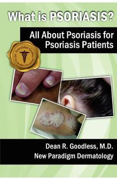 Coperta cărții 'What is Psoriasis?: All About Psoriasis for Psoriasis Patients - Dean R. Goodless Md'