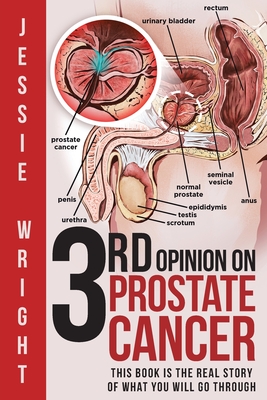 3rd Opinion on Prostate Cancer - Jessie Wright
