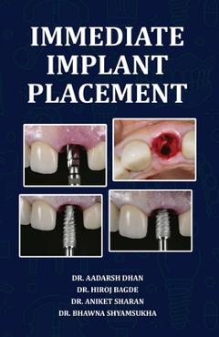 Coperta cărții 'Immediate Implant Placement - Aadarsh Dhan'