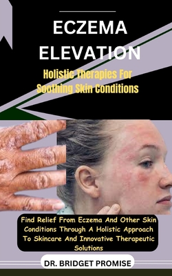Eczema Elevation: Holistic Therapies For Soothing Skin Conditions: Find Relief From Eczema And Other Skin Conditions Through A Holistic - Bridget Promise