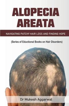 Coperta cărții 'Alopecia Areata - Navigating Patchy Hair Loss'