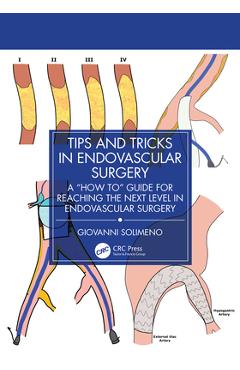 Tips and Tricks in Endovascular Surgery: A How to Guide for reaching the next Level in Endovascular Surgery - Giovanni Solimeno